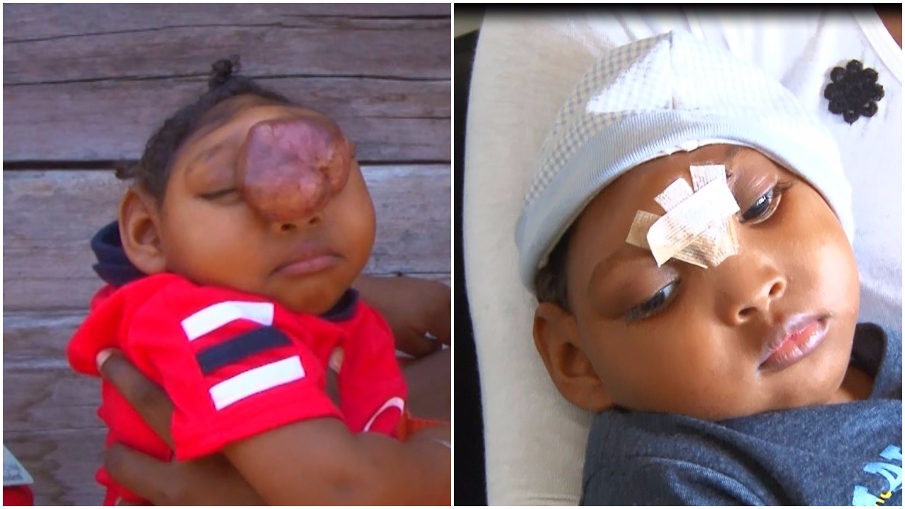 Toddler born with brain exposed undergoes successful surgery in Suriname