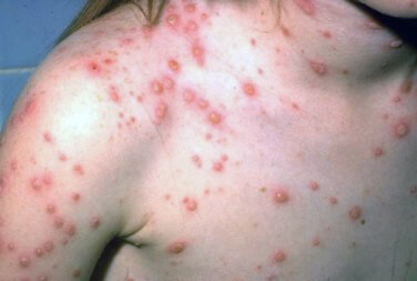 Ministry of Public Health addressing outbreak of chicken pox at Paramakatoi Secondary School dormitory